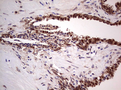 LGALS3 / Galectin 3 Antibody - Immunohistochemical staining of paraffin-embedded Human prostate tissue within the normal limits using anti-LGALS3 mouse monoclonal antibody. (Heat-induced epitope retrieval by 1 mM EDTA in 10mM Tris, pH8.5, 120C for 3min,