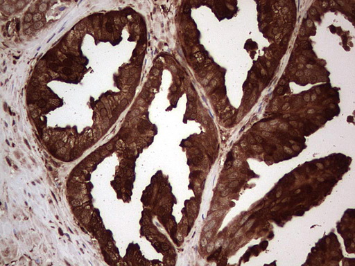 LGALS3 / Galectin 3 Antibody - Immunohistochemical staining of paraffin-embedded Carcinoma of Human prostate tissue using anti-LGALS3 mouse monoclonal antibody. (Heat-induced epitope retrieval by 1 mM EDTA in 10mM Tris, pH8.5, 120C for 3min,