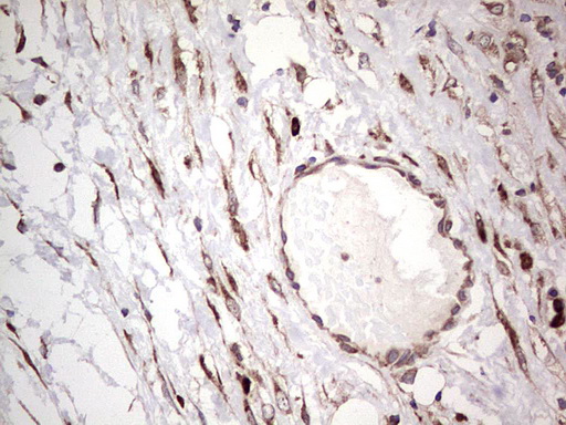 LGALS3 / Galectin 3 Antibody - Immunohistochemical staining of paraffin-embedded Carcinoma of Human bladder tissue using anti-LGALS3 mouse monoclonal antibody. (Heat-induced epitope retrieval by 1 mM EDTA in 10mM Tris, pH8.5, 120C for 3min,