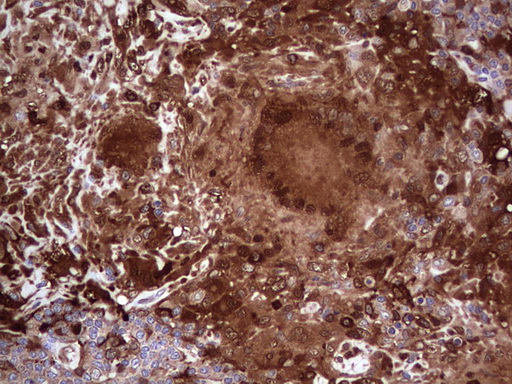 LGALS3 / Galectin 3 Antibody - Immunohistochemical staining of paraffin-embedded Human lymph node tissue within the normal limits using anti-LGALS3 mouse monoclonal antibody. (Heat-induced epitope retrieval by 1 mM EDTA in 10mM Tris, pH8.5, 120C for 3min,