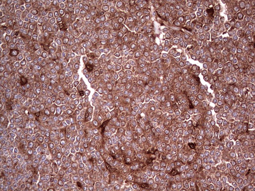 LGALS3 / Galectin 3 Antibody - Immunohistochemical staining of paraffin-embedded Human lymphoma tissue using anti-LGALS3 mouse monoclonal antibody. (Heat-induced epitope retrieval by 1 mM EDTA in 10mM Tris, pH8.5, 120C for 3min,