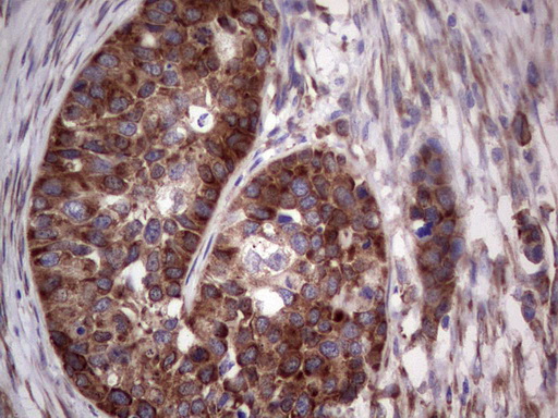 LGALS3 / Galectin 3 Antibody - Immunohistochemical staining of paraffin-embedded Carcinoma of Human kidney tissue using anti-LGALS3 mouse monoclonal antibody. (Heat-induced epitope retrieval by 1 mM EDTA in 10mM Tris, pH8.5, 120C for 3min,