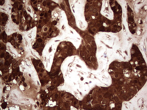 LGALS3 / Galectin 3 Antibody - Immunohistochemical staining of paraffin-embedded Carcinoma of Human liver tissue using anti-LGALS3 mouse monoclonal antibody. (Heat-induced epitope retrieval by 1 mM EDTA in 10mM Tris, pH8.5, 120C for 3min,