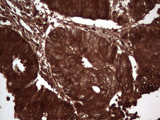 LGALS3 / Galectin 3 Antibody - IHC of paraffin-embedded Adenocarcinoma of Human colon tissue using anti-LGALS3 mouse monoclonal antibody. (Heat-induced epitope retrieval by 1 mM EDTA in 10mM Tris, pH8.5, 120°C for 3min).