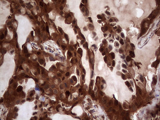 LGALS3 / Galectin 3 Antibody - Immunohistochemical staining of paraffin-embedded Carcinoma of Human lung tissue using anti-LGALS3 Mouse monoclonal antibody.  heat-induced epitope retrieval by 1 mM EDTA in 10mM Tris, pH8.5, 120C for 3min)