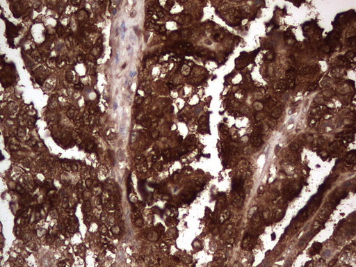 LGALS3 / Galectin 3 Antibody - Immunohistochemical staining of paraffin-embedded Adenocarcinoma of Human ovary tissue using anti-LGALS3 Mouse monoclonal antibody.  heat-induced epitope retrieval by 1 mM EDTA in 10mM Tris, pH8.5, 120C for 3min)