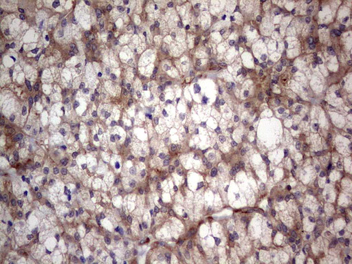 LGALS3 / Galectin 3 Antibody - Immunohistochemical staining of paraffin-embedded Carcinoma of Human thyroid tissue using anti-LGALS3 Mouse monoclonal antibody.  heat-induced epitope retrieval by 1 mM EDTA in 10mM Tris, pH8.5, 120C for 3min)