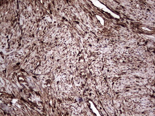 LGALS3 / Galectin 3 Antibody - Immunohistochemical staining of paraffin-embedded Adenocarcinoma of Human endometrium tissue using anti-LGALS3 Mouse monoclonal antibody.  heat-induced epitope retrieval by 1 mM EDTA in 10mM Tris, pH8.5, 120C for 3min)