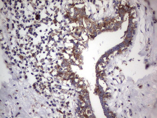 LGALS3 / Galectin 3 Antibody - Immunohistochemical staining of paraffin-embedded Adenocarcinoma of Human breast tissue using anti-LGALS3 Mouse monoclonal antibody.  heat-induced epitope retrieval by 1 mM EDTA in 10mM Tris, pH8.5, 120C for 3min)