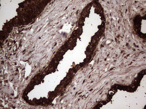 LGALS3 / Galectin 3 Antibody - Immunohistochemical staining of paraffin-embedded Carcinoma of Human prostate tissue using anti-LGALS3 Mouse monoclonal antibody.  heat-induced epitope retrieval by 1 mM EDTA in 10mM Tris, pH8.5, 120C for 3min)