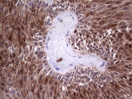 LGALS3 / Galectin 3 Antibody - Immunohistochemical staining of paraffin-embedded Carcinoma of Human bladder tissue using anti-LGALS3 Mouse monoclonal antibody.  heat-induced epitope retrieval by 1 mM EDTA in 10mM Tris, pH8.5, 120C for 3min)