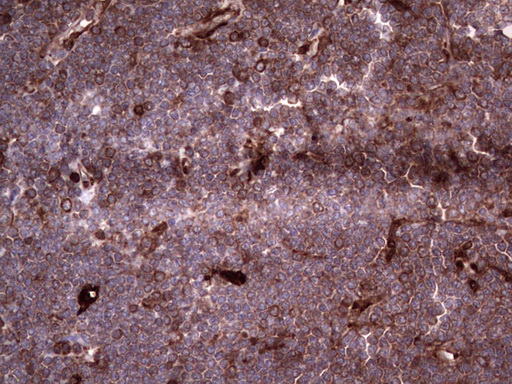 LGALS3 / Galectin 3 Antibody - Immunohistochemical staining of paraffin-embedded Human lymphoma tissue using anti-LGALS3 Mouse monoclonal antibody.  heat-induced epitope retrieval by 1 mM EDTA in 10mM Tris, pH8.5, 120C for 3min)