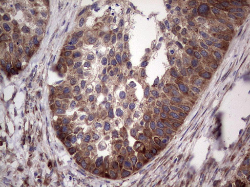 LGALS3 / Galectin 3 Antibody - Immunohistochemical staining of paraffin-embedded Carcinoma of Human kidney tissue using anti-LGALS3 Mouse monoclonal antibody.  heat-induced epitope retrieval by 1 mM EDTA in 10mM Tris, pH8.5, 120C for 3min)