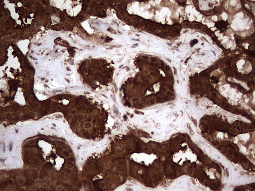 LGALS3 / Galectin 3 Antibody - Immunohistochemical staining of paraffin-embedded Carcinoma of Human liver tissue using anti-LGALS3 Mouse monoclonal antibody.  heat-induced epitope retrieval by 1 mM EDTA in 10mM Tris, pH8.5, 120C for 3min)