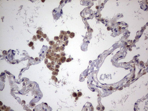 LGALS3 / Galectin 3 Antibody - Immunohistochemical staining of paraffin-embedded Human lung tissue within the normal limits using anti-LGALS3 Mouse monoclonal antibody.  heat-induced epitope retrieval by 1 mM EDTA in 10mM Tris, pH8.5, 120C for 3min)
