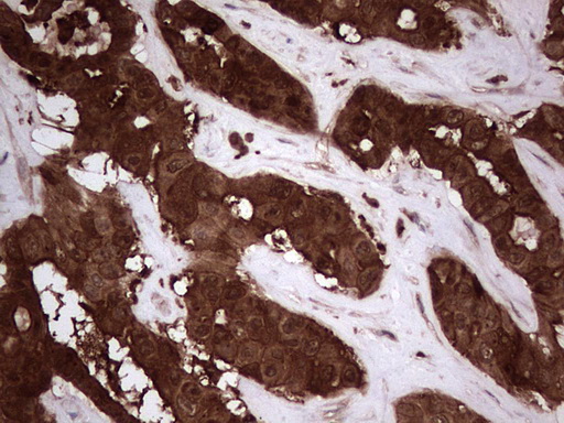 LGALS3 / Galectin 3 Antibody - IHC of paraffin-embedded Carcinoma of Human liver tissue using anti-LGALS3 mouse monoclonal antibody. (Heat-induced epitope retrieval by 1 mM EDTA in 10mM Tris, pH8.5, 120°C for 3min).