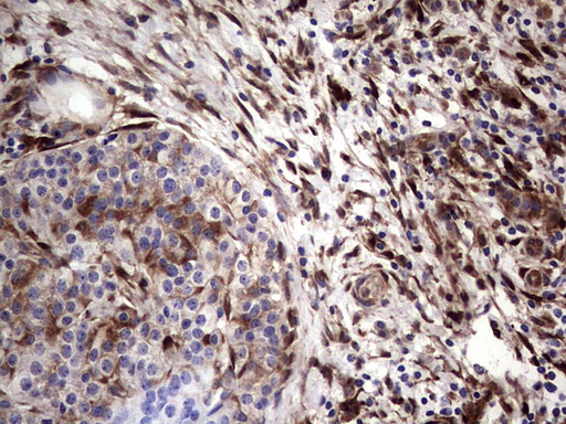 LGALS3 / Galectin 3 Antibody - IHC of paraffin-embedded Carcinoma of Human pancreas tissue using anti-LGALS3 mouse monoclonal antibody. (Heat-induced epitope retrieval by 1 mM EDTA in 10mM Tris, pH8.5, 120°C for 3min).