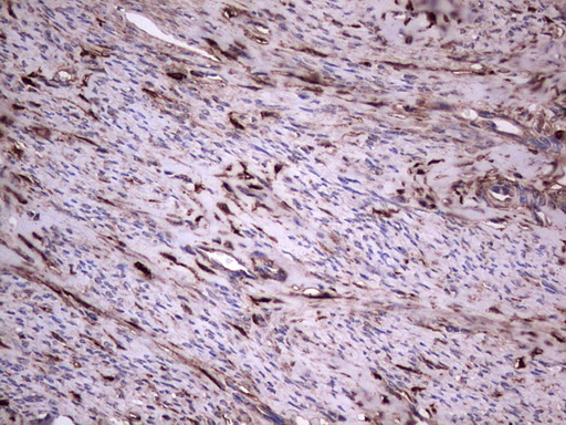 LGALS3 / Galectin 3 Antibody - IHC of paraffin-embedded Adenocarcinoma of Human endometrium tissue using anti-LGALS3 mouse monoclonal antibody. (Heat-induced epitope retrieval by 1 mM EDTA in 10mM Tris, pH8.5, 120°C for 3min).