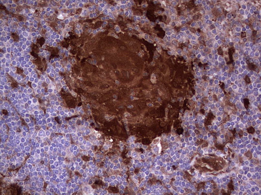 LGALS3 / Galectin 3 Antibody - IHC of paraffin-embedded Human lymph node tissue using anti-LGALS3 mouse monoclonal antibody. (Heat-induced epitope retrieval by 1 mM EDTA in 10mM Tris, pH8.5, 120°C for 3min).