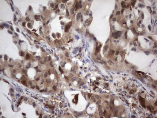LGALS3 / Galectin 3 Antibody - Immunohistochemical staining of paraffin-embedded Carcinoma of Human lung tissue using anti-LGALS3 mouse monoclonal antibody. (Heat-induced epitope retrieval by 1 mM EDTA in 10mM Tris, pH8.5, 120C for 3min,