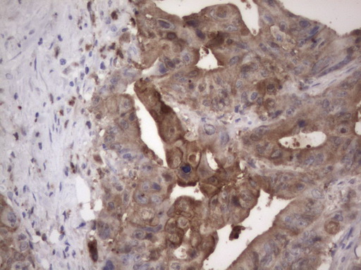LGALS3 / Galectin 3 Antibody - Immunohistochemical staining of paraffin-embedded Adenocarcinoma of Human colon tissue using anti-LGALS3 mouse monoclonal antibody. (Heat-induced epitope retrieval by 1 mM EDTA in 10mM Tris, pH8.5, 120C for 3min,