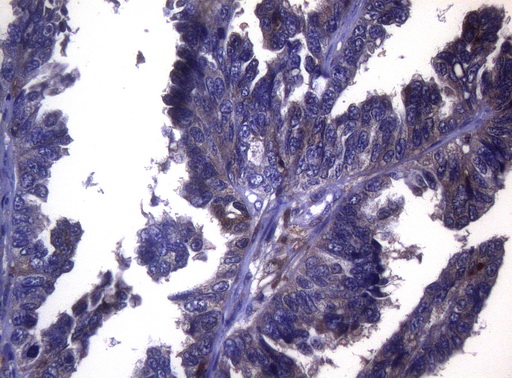 LGALS3 / Galectin 3 Antibody - Immunohistochemical staining of paraffin-embedded Adenocarcinoma of Human ovary tissue using anti-LGALS3 mouse monoclonal antibody. (Heat-induced epitope retrieval by 1mM EDTA in 10mM Tris buffer. (pH8.5) at 120°C for 3 min. (1:150)