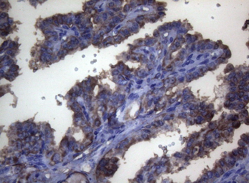 LGALS3 / Galectin 3 Antibody - Immunohistochemical staining of paraffin-embedded Carcinoma of Human thyroid tissue using anti-LGALS3 mouse monoclonal antibody. (Heat-induced epitope retrieval by 1mM EDTA in 10mM Tris buffer. (pH8.5) at 120°C for 3 min. (1:150)