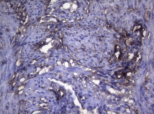 LGALS3 / Galectin 3 Antibody - Immunohistochemical staining of paraffin-embedded Human endometrium tissue within the normal limits using anti-LGALS3 mouse monoclonal antibody. (Heat-induced epitope retrieval by 1mM EDTA in 10mM Tris buffer. (pH8.5) at 120°C for 3 min. (1:150)