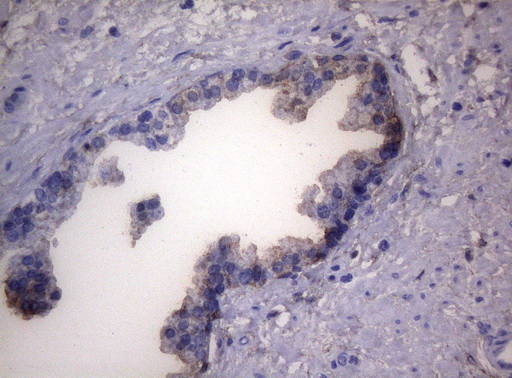 LGALS3 / Galectin 3 Antibody - Immunohistochemical staining of paraffin-embedded Carcinoma of Human prostate tissue using anti-LGALS3 mouse monoclonal antibody. (Heat-induced epitope retrieval by 1mM EDTA in 10mM Tris buffer. (pH8.5) at 120°C for 3 min. (1:150)