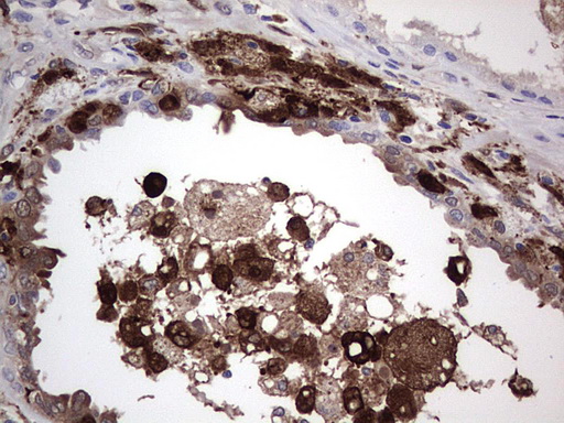 LGALS3 / Galectin 3 Antibody - Immunohistochemical staining of paraffin-embedded Human prostate tissue within the normal limits using anti-LGALS3 Mouse monoclonal antibody.  heat-induced epitope retrieval by 1 mM EDTA in 10mM Tris, pH8.5, 120C for 3min)