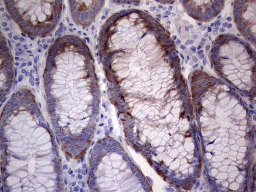 LGALS3 / Galectin 3 Antibody - Immunohistochemical staining of paraffin-embedded Human colon tissue within the normal limits using anti-LGALS3 Mouse monoclonal antibody.  heat-induced epitope retrieval by 1 mM EDTA in 10mM Tris, pH8.5, 120C for 3min)