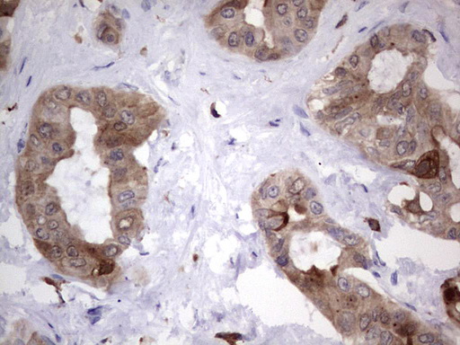 LGALS3 / Galectin 3 Antibody - Immunohistochemical staining of paraffin-embedded Carcinoma of Human liver tissue using anti-LGALS3 Mouse monoclonal antibody.  heat-induced epitope retrieval by 1 mM EDTA in 10mM Tris, pH8.5, 120C for 3min)