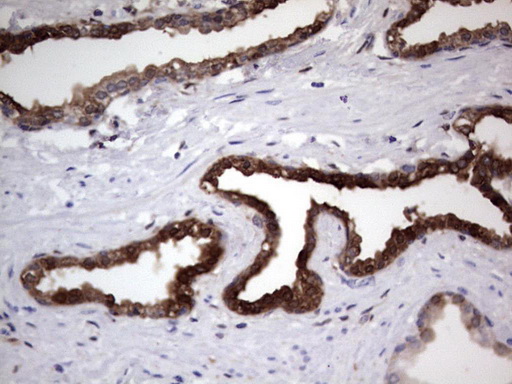 LGALS3 / Galectin 3 Antibody - IHC of paraffin-embedded Carcinoma of Human prostate tissue using anti-LGALS3 Mouse monoclonal antibody. (heat-induced epitope retrieval by 1 mM EDTA in 10mM Tris, pH8.5, 120°C for 3min).