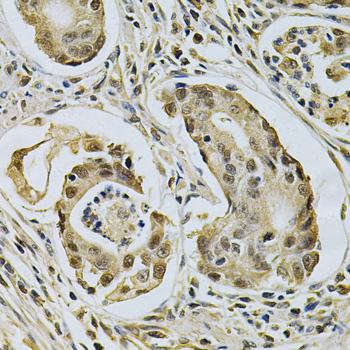 LGALS3 / Galectin 3 Antibody - Immunohistochemistry of paraffin-embedded human gastric cancer using LGALS3 Antibodyat dilution of 1:200 (40x lens).