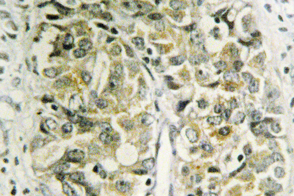 LGALS8 / Galectin 8 Antibody - IHC of Galectin-8 (N82) pAb in paraffin-embedded human prostate carcinoma tissue.
