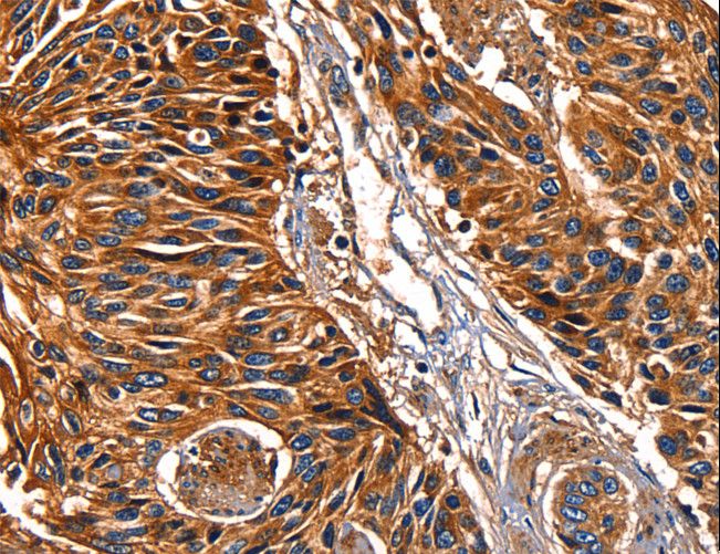 LGALS8 / Galectin 8 Antibody - Immunohistochemistry of paraffin-embedded Human lung cancer using LGALS8 Polyclonal Antibody at dilution of 1:50.
