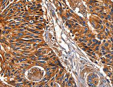 LGALS8 / Galectin 8 Antibody - Immunohistochemistry of paraffin-embedded Human lung cancer using LGALS8 Polyclonal Antibody at dilution of 1:50.