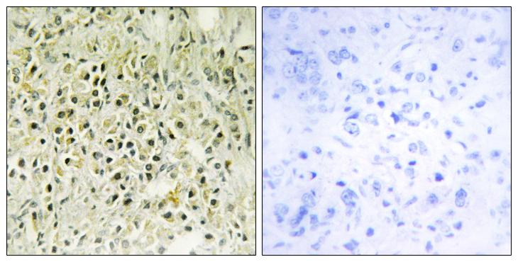 LGALS8 / Galectin 8 Antibody - Peptide - + Immunohistochemistry analysis of paraffin-embedded human prostate carcinoma tissue using LEG8 antibody.