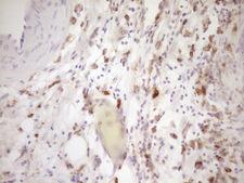 LGALS9 / Galectin 9 Antibody - Immunohistochemical staining of paraffin-embedded Carcinoma of Human pancreas tissue using anti-LGALS9 mouse monoclonal antibody. (Heat-induced epitope retrieval by Tris-EDTA, pH8.0) Dilution: 1:150