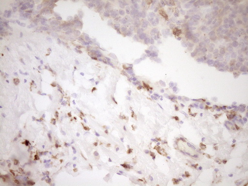 LGALS9 / Galectin 9 Antibody - Immunohistochemical staining of paraffin-embedded Adenocarcinoma of Human breast tissue using anti-LGALS9 mouse monoclonal antibody. (Heat-induced epitope retrieval by Tris-EDTA, pH8.0) Dilution: 1:150