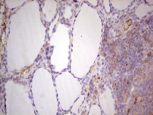 LGALS9 / Galectin 9 Antibody - Immunohistochemical staining of paraffin-embedded Human thyroid tissue within the normal limits using anti-LGALS9 mouse monoclonal antibody. (Heat-induced epitope retrieval by 1 mM EDTA in 10mM Tris, pH8.5, 120C for 3min,