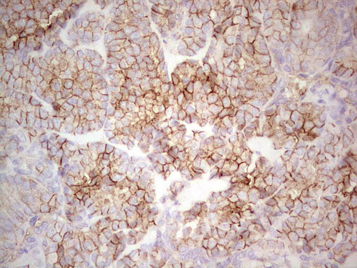 LGALS9 / Galectin 9 Antibody - Immunohistochemical staining of paraffin-embedded Carcinoma of Human thyroid tissue using anti-LGALS9 mouse monoclonal antibody. (Heat-induced epitope retrieval by 1 mM EDTA in 10mM Tris, pH8.5, 120C for 3min,