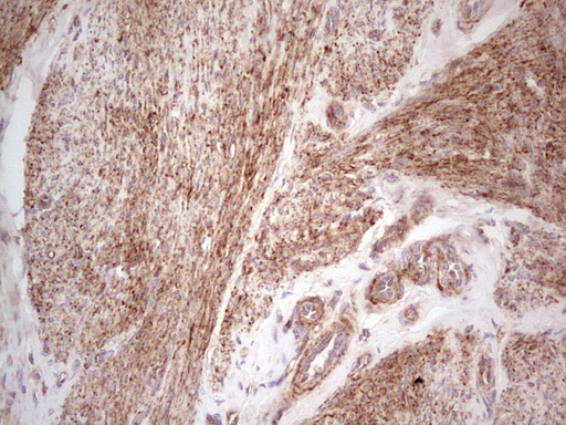 LGALS9 / Galectin 9 Antibody - Immunohistochemical staining of paraffin-embedded Adenocarcinoma of Human endometrium tissue using anti-LGALS9 mouse monoclonal antibody. (Heat-induced epitope retrieval by 1 mM EDTA in 10mM Tris, pH8.5, 120C for 3min,