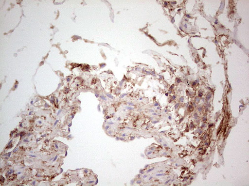 LGALS9 / Galectin 9 Antibody - Immunohistochemical staining of paraffin-embedded Carcinoma of Human kidney tissue using anti-LGALS9 mouse monoclonal antibody. (Heat-induced epitope retrieval by 1 mM EDTA in 10mM Tris, pH8.5, 120C for 3min,