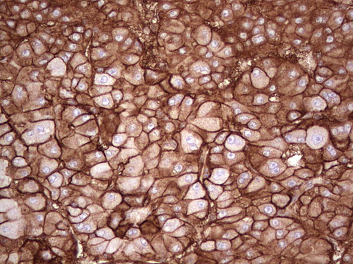 LGALS9 / Galectin 9 Antibody - Immunohistochemical staining of paraffin-embedded Carcinoma of Human liver tissue using anti-LGALS9 mouse monoclonal antibody. (Heat-induced epitope retrieval by 1 mM EDTA in 10mM Tris, pH8.5, 120C for 3min,
