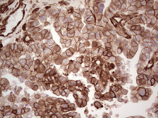 LGALS9 / Galectin 9 Antibody - Immunohistochemical staining of paraffin-embedded Adenocarcinoma of Human ovary tissue using anti-LGALS9 mouse monoclonal antibody. (Heat-induced epitope retrieval by 1 mM EDTA in 10mM Tris, pH8.5, 120C for 3min,
