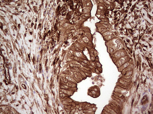 LGALS9 / Galectin 9 Antibody - Immunohistochemical staining of paraffin-embedded Carcinoma of Human pancreas tissue using anti-LGALS9 mouse monoclonal antibody. (Heat-induced epitope retrieval by 1 mM EDTA in 10mM Tris, pH8.5, 120C for 3min,