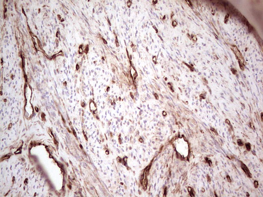 LGALS9 / Galectin 9 Antibody - Immunohistochemical staining of paraffin-embedded Adenocarcinoma of Human endometrium tissue using anti-LGALS9 mouse monoclonal antibody. (Heat-induced epitope retrieval by 1 mM EDTA in 10mM Tris, pH8.5, 120C for 3min,