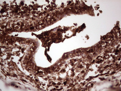 LGALS9 / Galectin 9 Antibody - Immunohistochemical staining of paraffin-embedded Adenocarcinoma of Human breast tissue using anti-LGALS9 mouse monoclonal antibody. (Heat-induced epitope retrieval by 1 mM EDTA in 10mM Tris, pH8.5, 120C for 3min,