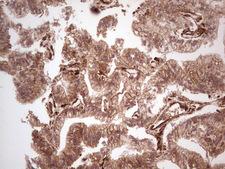 LGALS9 / Galectin 9 Antibody - Immunohistochemical staining of paraffin-embedded Carcinoma of Human prostate tissue using anti-LGALS9 mouse monoclonal antibody. (Heat-induced epitope retrieval by 1 mM EDTA in 10mM Tris, pH8.5, 120C for 3min,